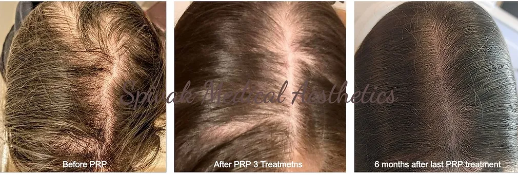PRP-hair-before-after-Masha-before-after-Spivak-Medical-Aeshetics-in-Sudbury-MA
